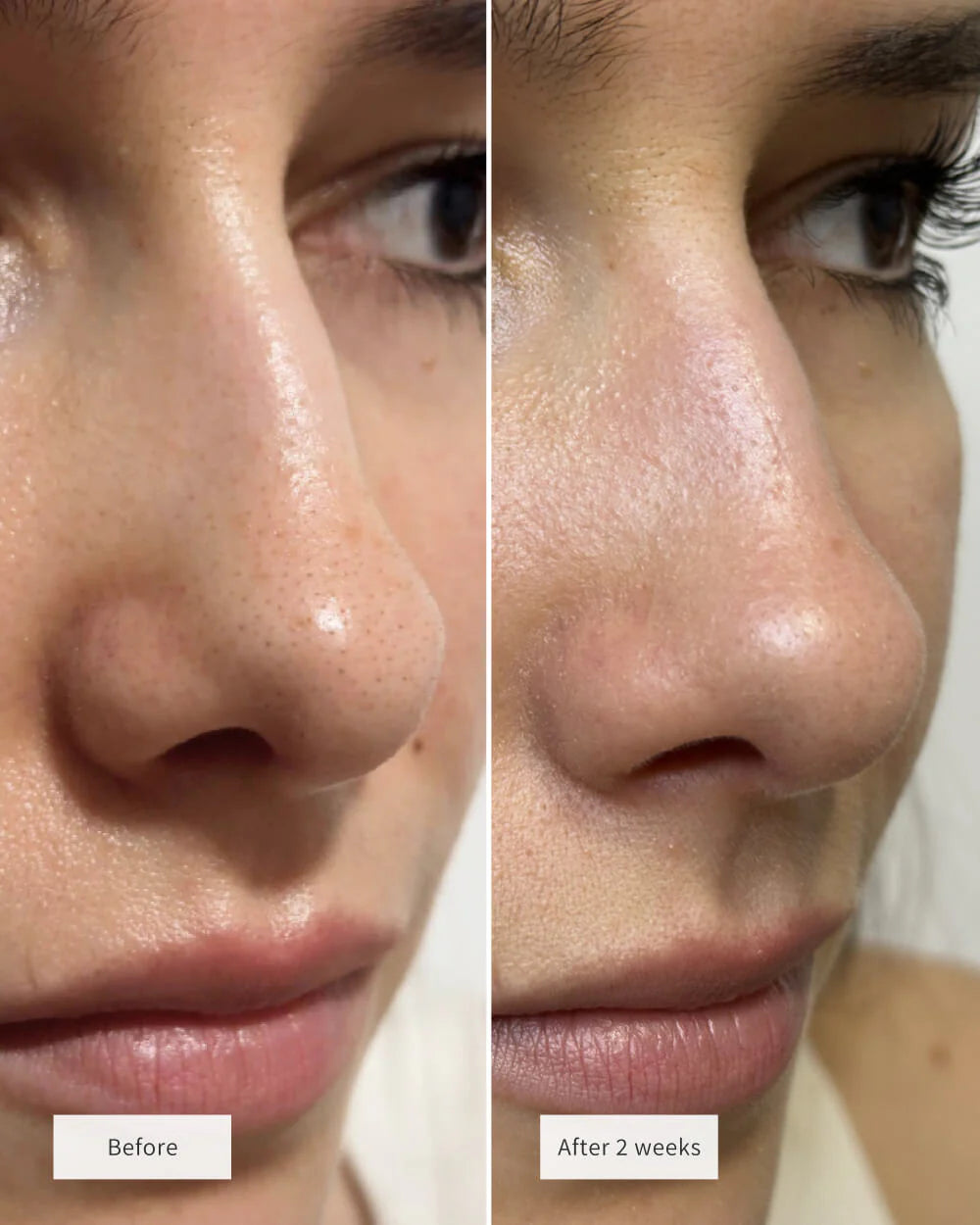 Clinclii nose patches